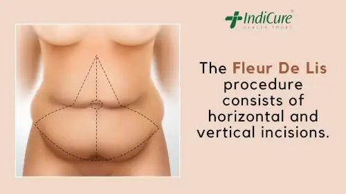 Fleur De Lis Abdominoplasty Technique